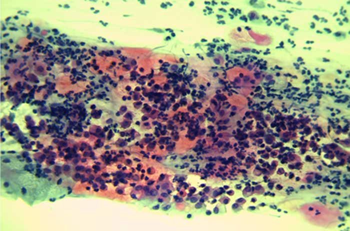 Typisches Zellbild eines gefärbten zytolgischen Abtrichs auf einem Objektträger.